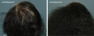 Önce Sonra Saç HairMax