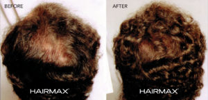 Önce Sonra Saç HairMax