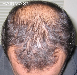 Hairmax Önce Sonra Saç Mor Medikal